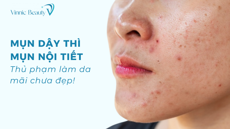 Mụn đã hết, sao da vẫn xấu? Cách phục hồi sau thâm mụn và sẹo