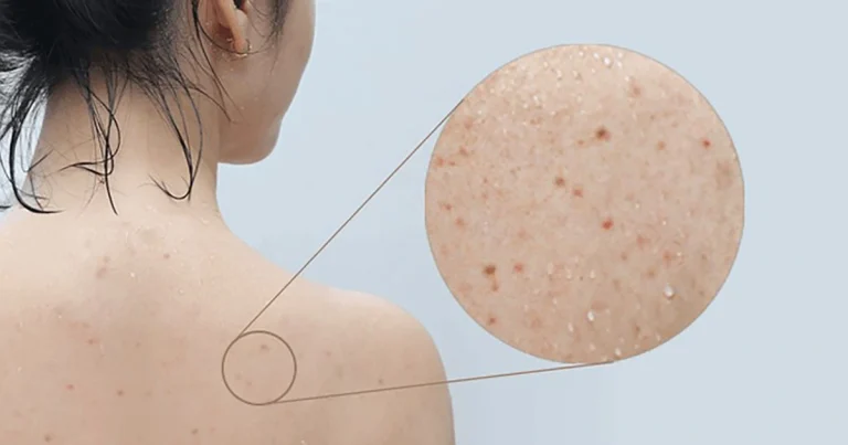 Trị Mụn Lưng Chuẩn Y Khoa – Phương Pháp Được Bác Sĩ Da Liễu Khuyên Dùng